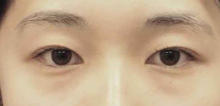 湘南美容クリニック 渋谷院で切る二重術（切開法）：全切開法二重術を受けたルイさんの写真