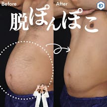 【男性・腹部】クールスカルプティング_before_aftar