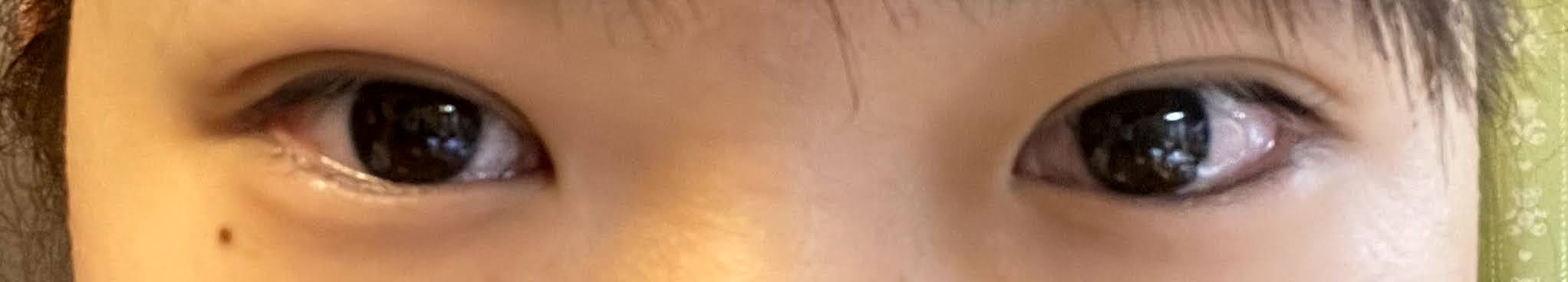 湘南美容クリニック  名古屋院で二重埋没を受けたゆさんの写真