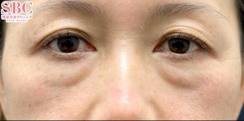 【40代女性・目元】裏ハムラ法 SBCプレミアムPRP皮膚再生療法_before