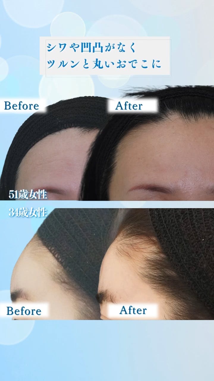 【51歳女性・額】ヒアルロン酸注入_before_aftar