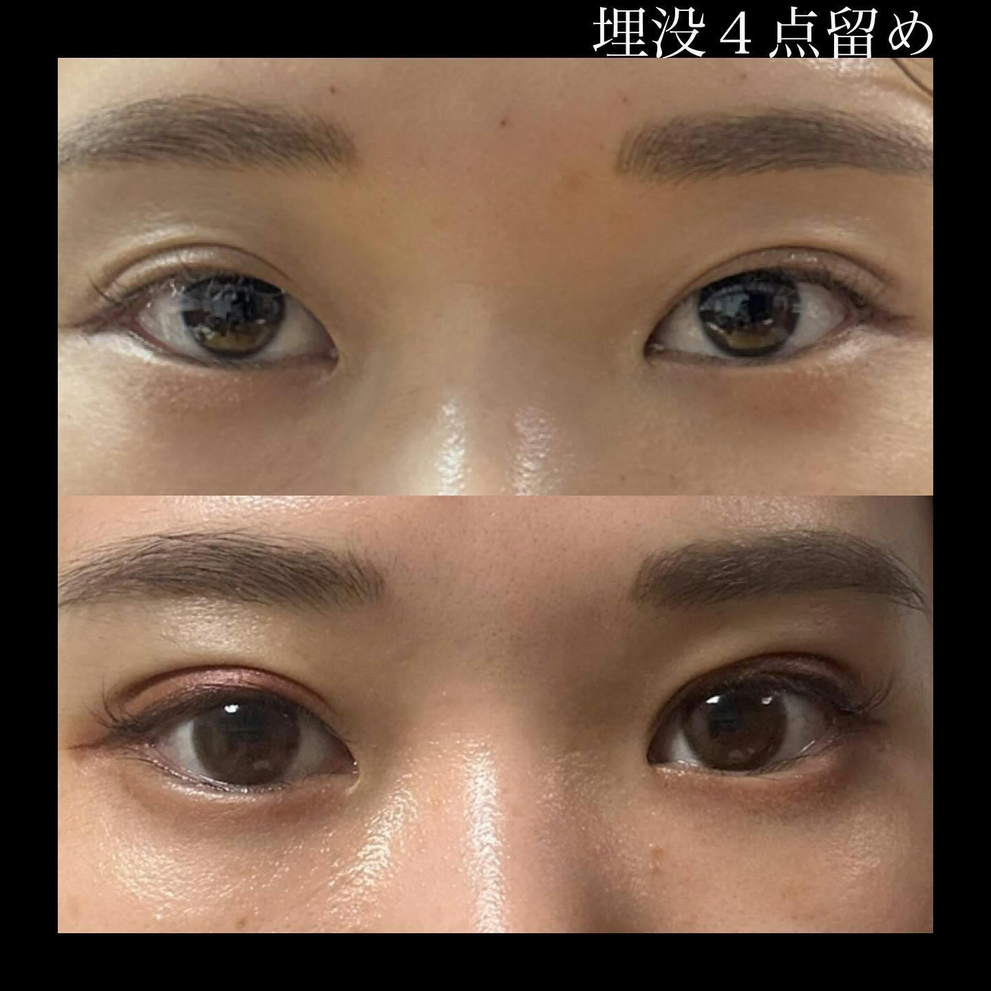 【女性・目元】二重まぶた埋没法4点留め_before_aftar