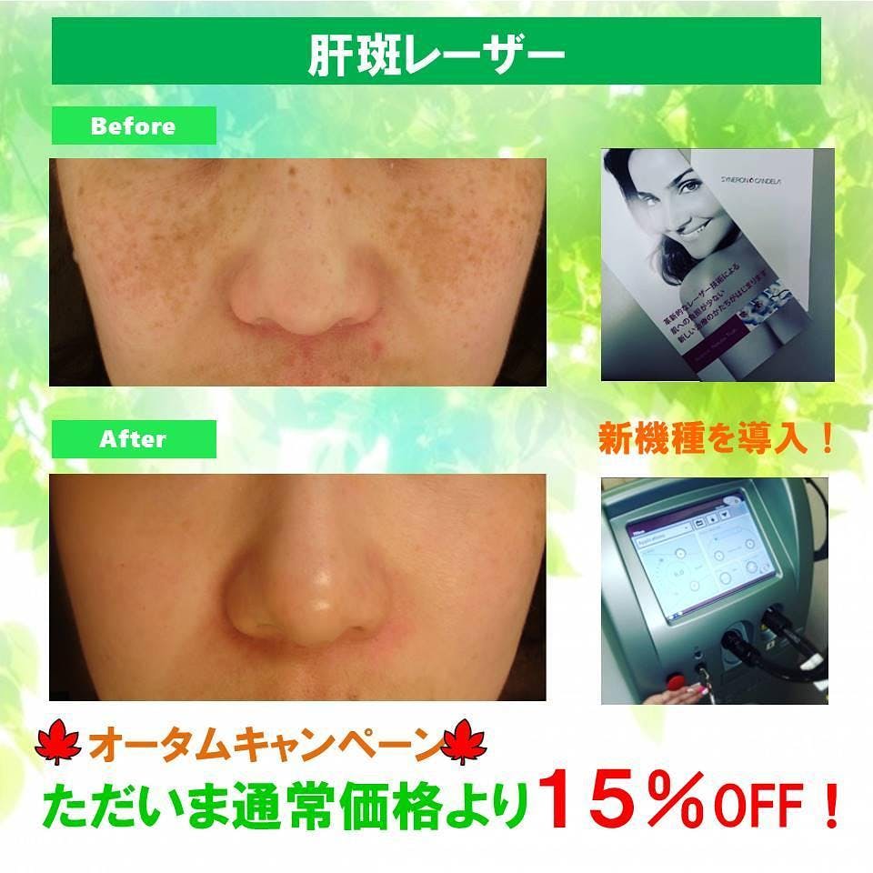 【50代女性・シミ】肝斑レーザー_before_aftar