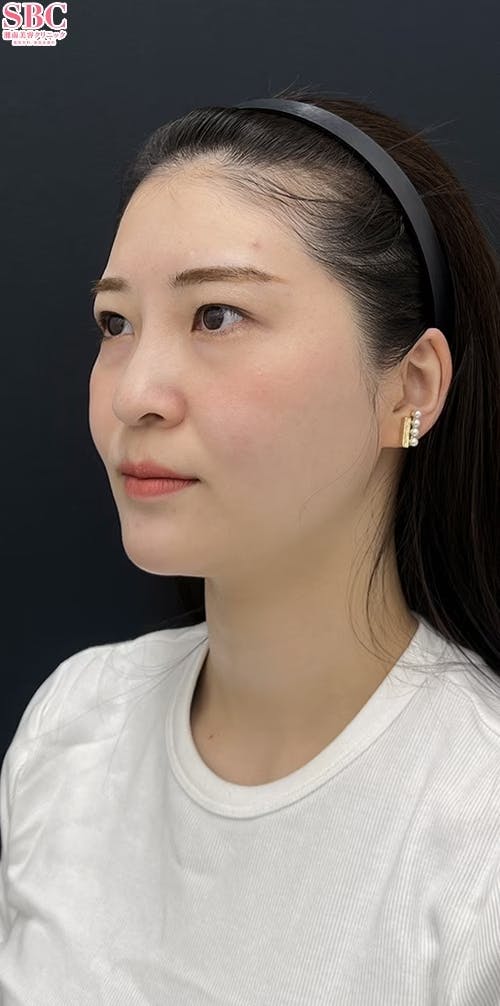 【20代女性・輪郭】根こそぎVASER脂肪吸引_before