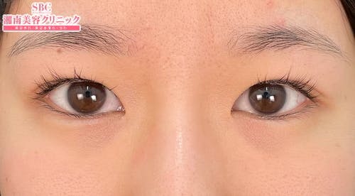 【女性・目元】線留めクロス二重術_before