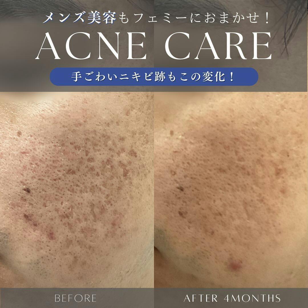 【男性・ニキビ】ACRS_before_aftar