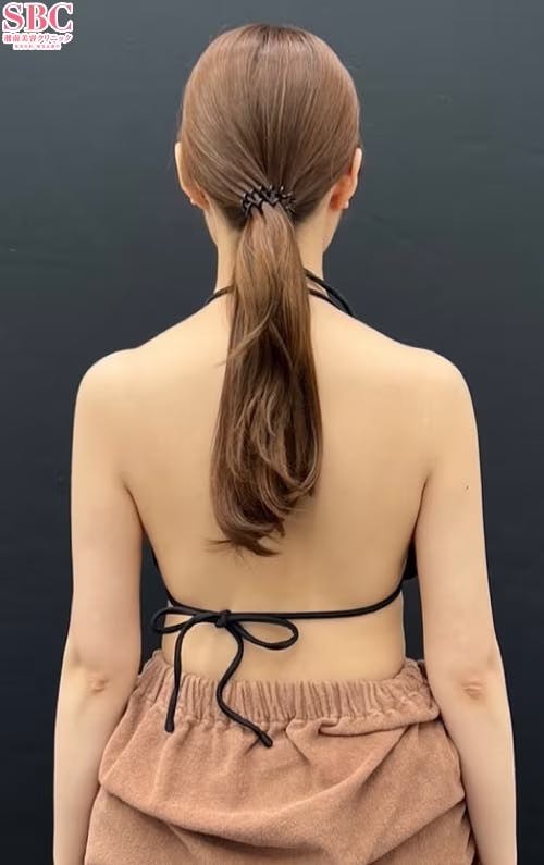 【女性・二の腕】根こそぎVASER脂肪吸引_after