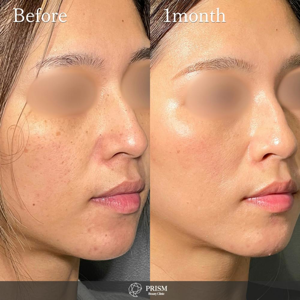 【30代女性・顔】美人レーザー（MIINレーザー) 【スポット シミ取り放題】_before_aftar