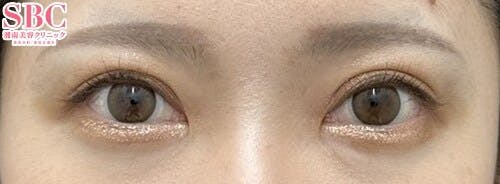 【30代女性・目元】線留めクロス二重術・自然癒着法_after