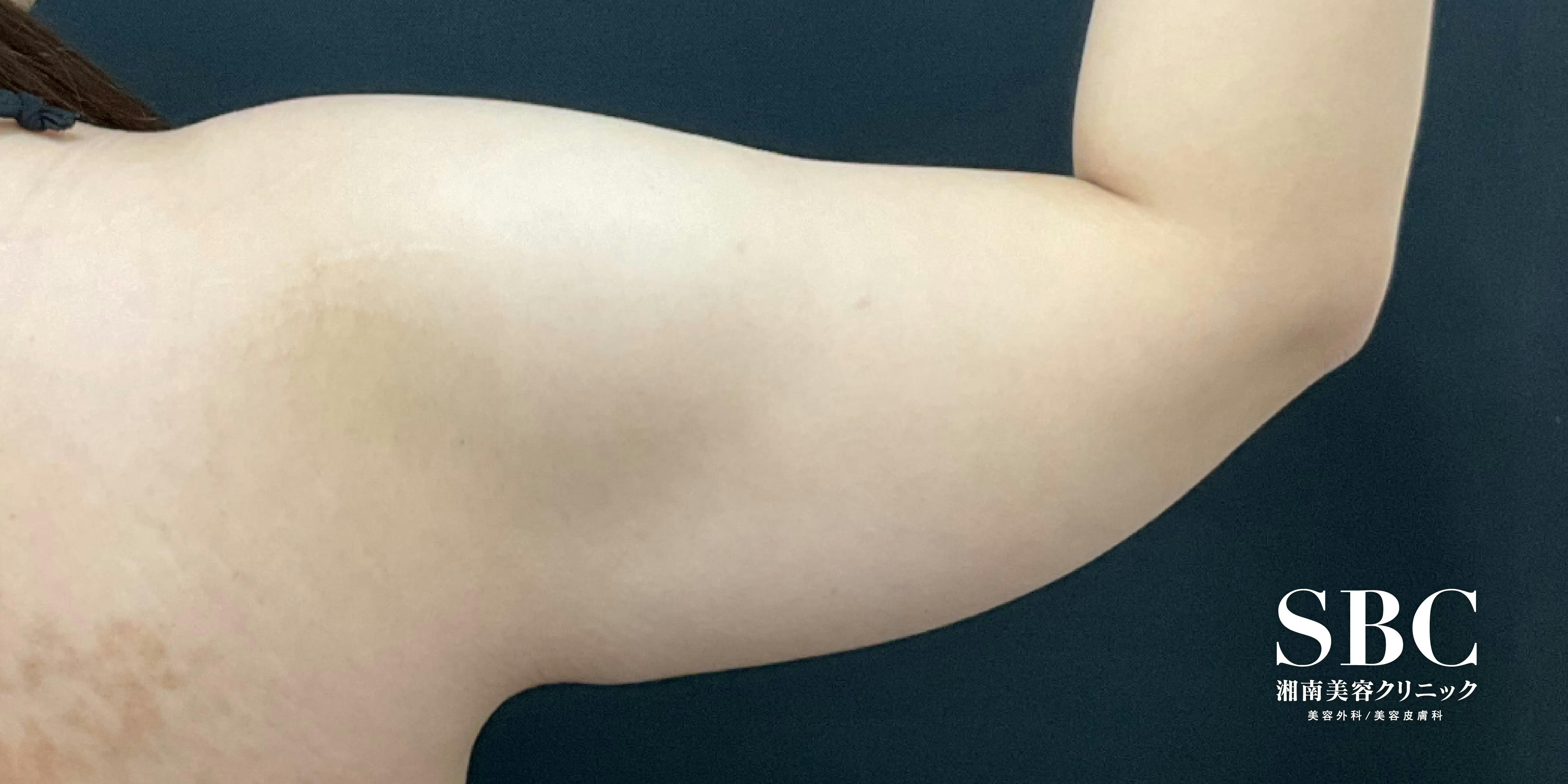 【女性・上半身・二の腕】Aquicell（アキーセル）脂肪吸引_before