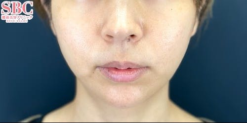 【女性・顔】VOV（ボブ）リフト、プリマリフト_after