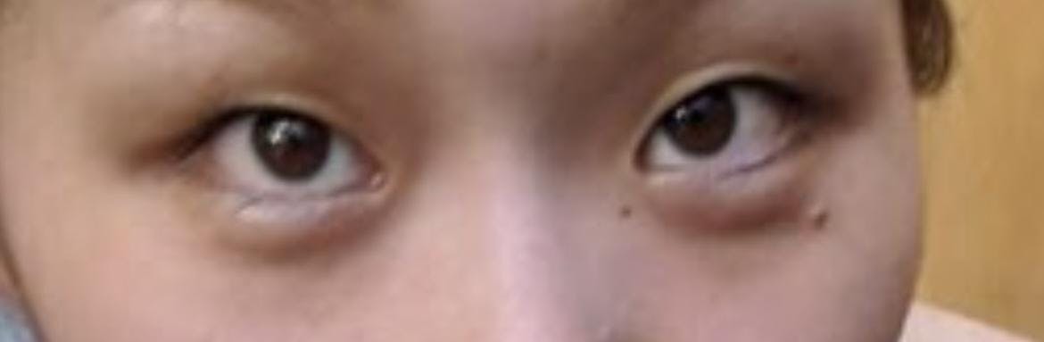 城本クリニック福岡院で外科的涙袋形成を受けたりりさんの写真