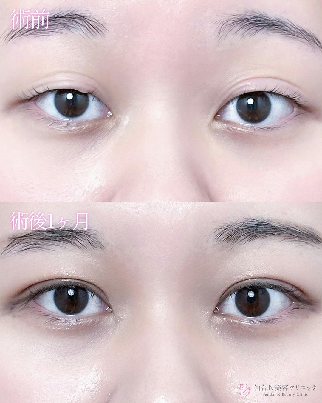 【女性・目元】二重埋没法（シークレットトリプル）_before_aftar