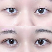 【女性・目元】二重埋没法(シークレットトリプル)_before_aftar