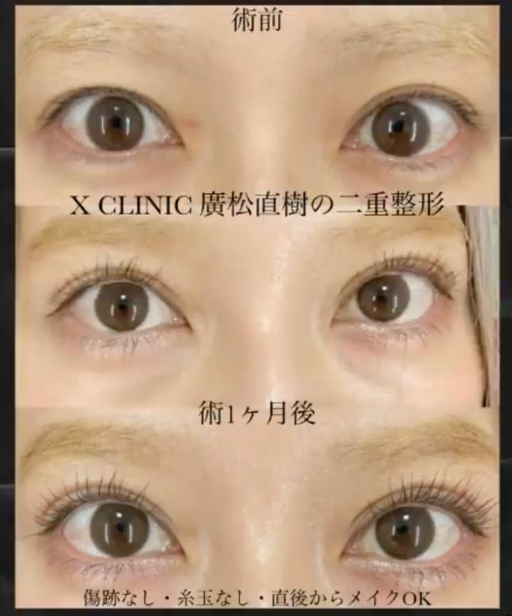 【女性・目元】Xクロスダブル(埋没法二重術)_before_aftar