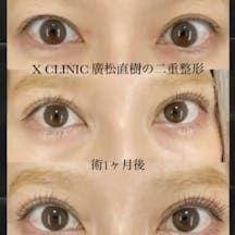 【女性・目元】Xクロスダブル(埋没法二重術)_before_aftar