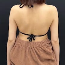 【女性・二の腕】根こそぎVASER脂肪吸引_after