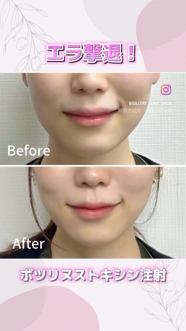 【女性・エラ】エラボトックス_before_aftar