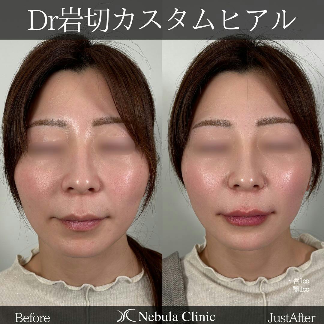 【女性・唇・顎】ヒアルロン酸注入(唇・顎)_before_aftar