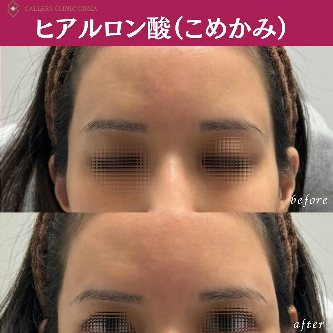【女性・丸み】ヒアルロン酸(こめかみ)_before_aftar