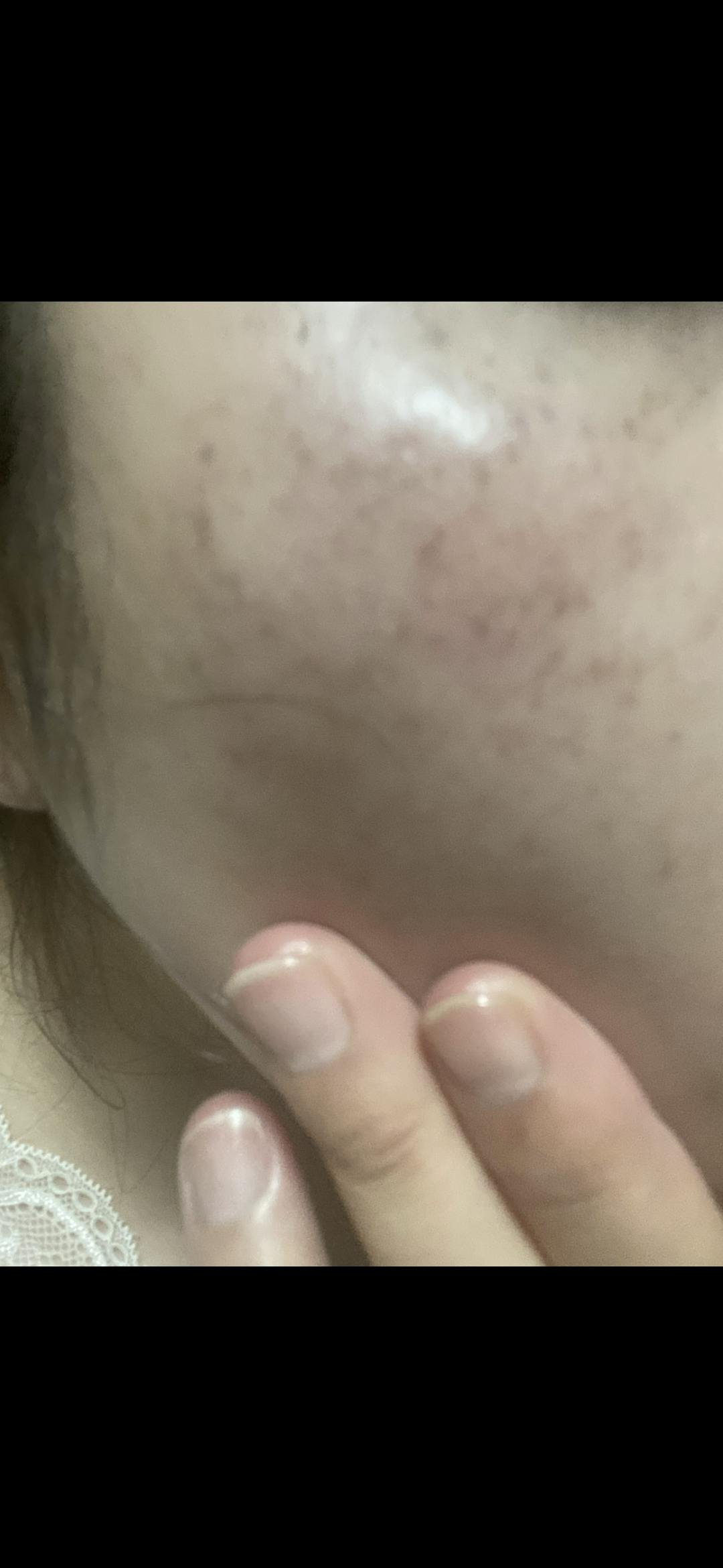 品川スキンクリニック岡山院でを受けたマチルダさんの写真