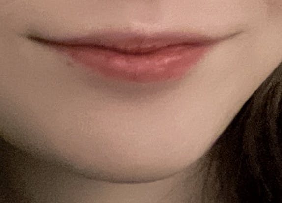 湘南美容クリニック 池袋メトロポリタン口院でを受けたあさんの写真