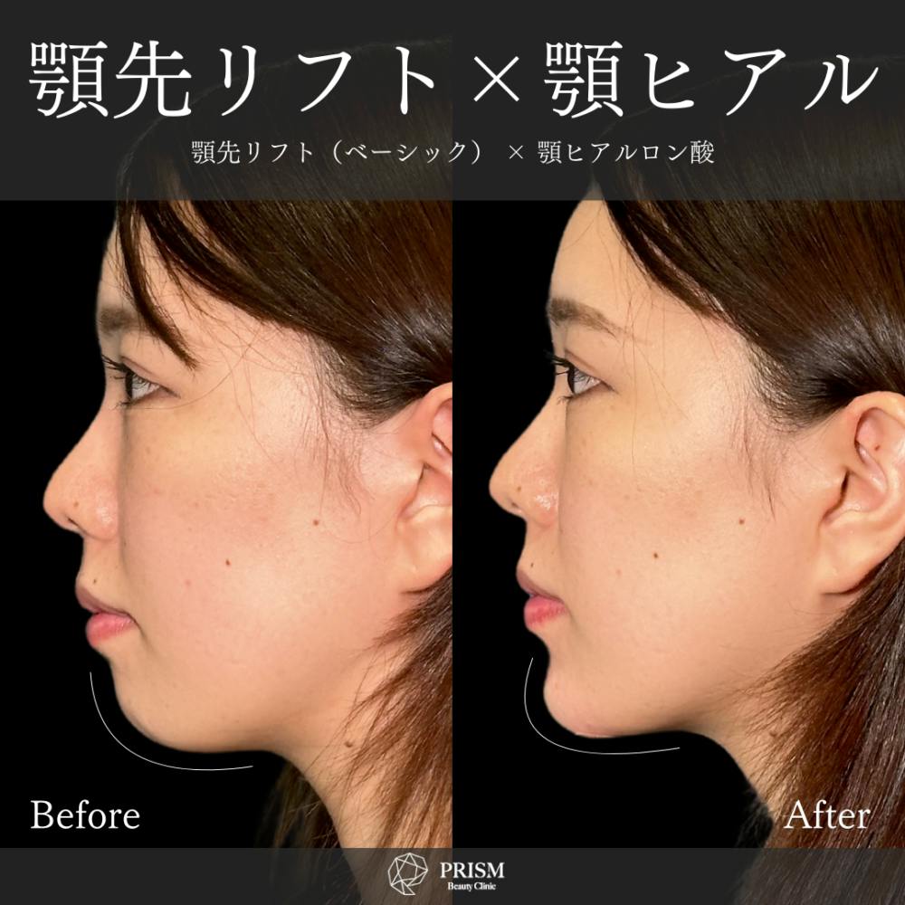 【20代女性・顎】あご先リフト＋ ヒアルロン酸（顎）_before_aftar