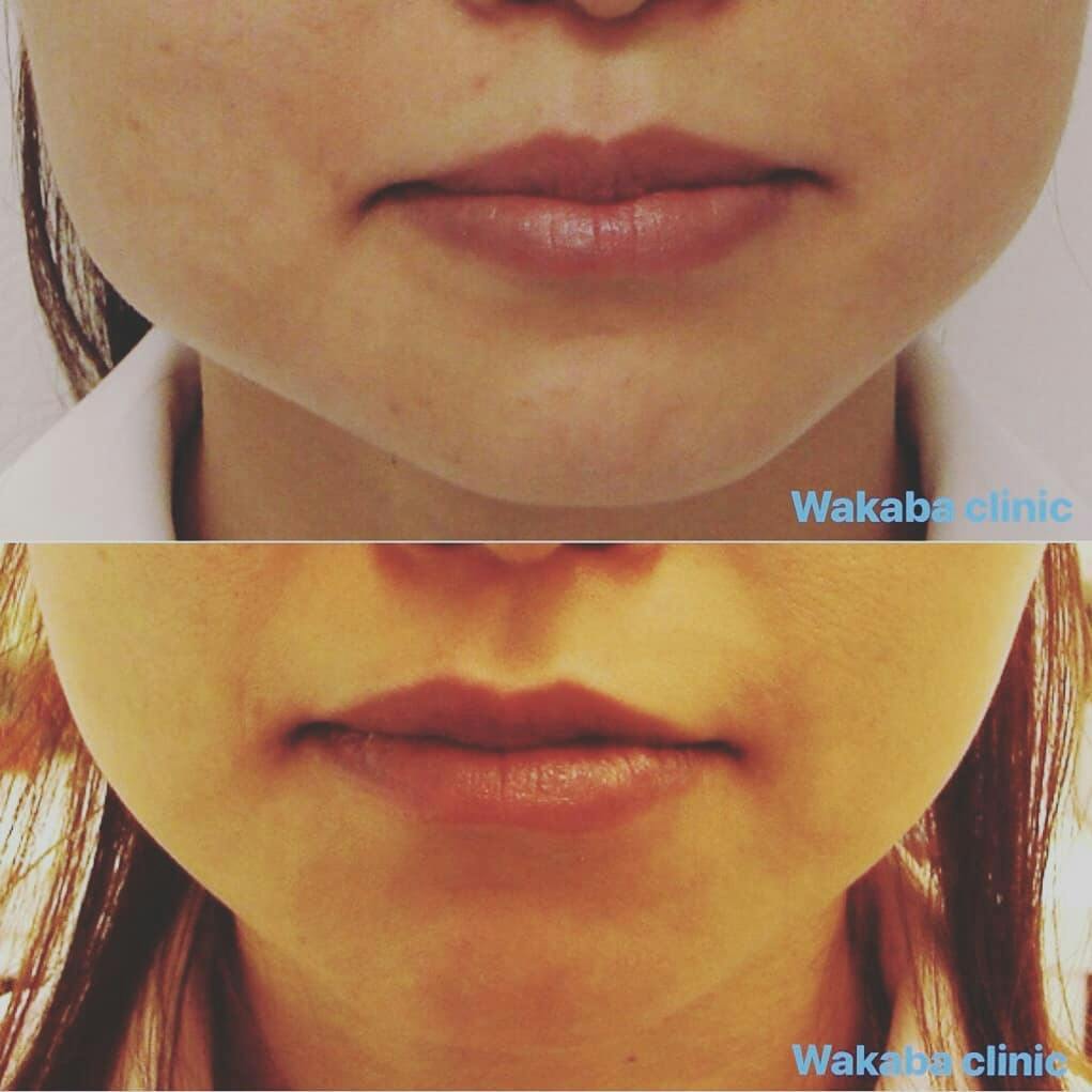 【女性・エラ】ボトックス_before_aftar