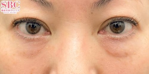 【女性・クマ】切開ハムラ(表ハムラ)法_before