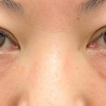 【女性・クマ】切開ハムラ(表ハムラ)法_before