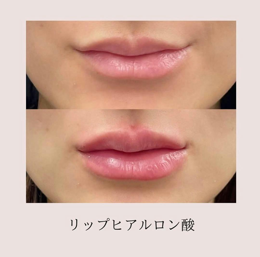 【女性・唇】ヒアルロン酸ボルベラ1cc_before_aftar