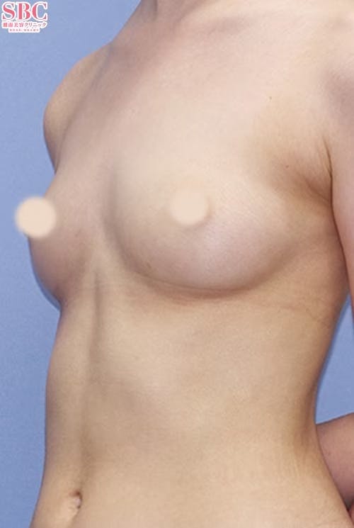 【女性・胸】Aquicell（アキーセル）併用セルーション(脂肪注入豊胸)・セルーション(脂肪注入豊胸)_before