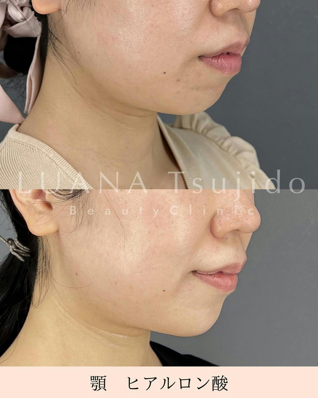 【女性・顎】ヒアルロン酸_before_aftar