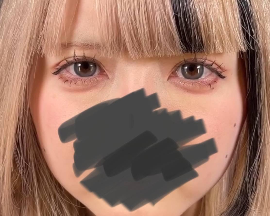 品川美容外科上野院で二重整形：二重術ナチュラル法（二重埋没法）3点留めを受けたOMUさんの写真