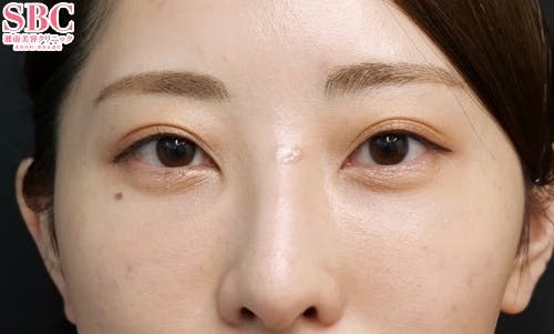 【20代女性・クマ】目の下の切らないクマ・たるみ（ふくらみ）取り ナチュラル脂肪注射コンデンスリッチ_aftar