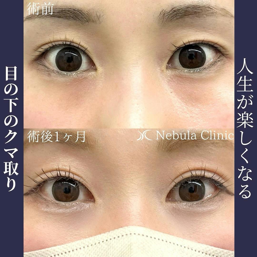 【女性・クマ】切らない目の下のクマ取り・たるみ取り_before_aftar