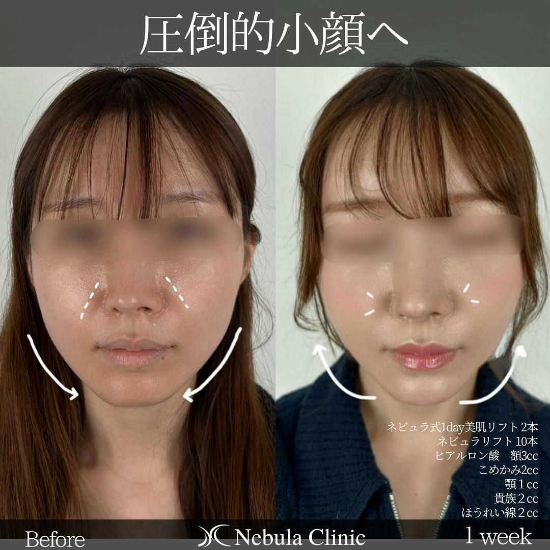 【女性・顔・額・こめかみ・顎・小鼻・法令線】糸リフト、ヒアルロン酸注入(額・こめかみ・顎・貴族・法令線)_before_aftar