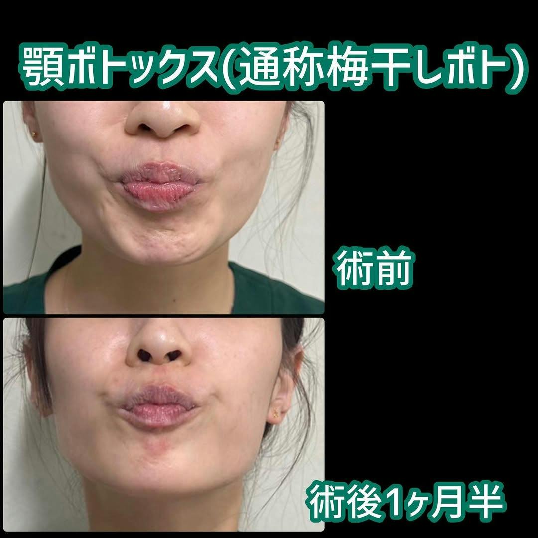 【女性・シワ】マイクロボトックス_before_aftar