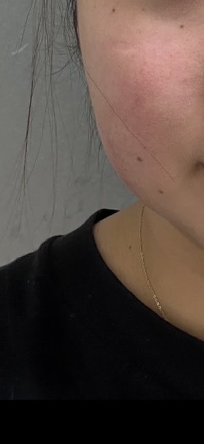 湘南美容クリニック 大阪梅田本院でボトックス注射・エラボトックス注射(小顔)・韓国製ボトックス・ボツリヌストキシン・アラガン製ボトックスを受けたnaagiiさんの写真