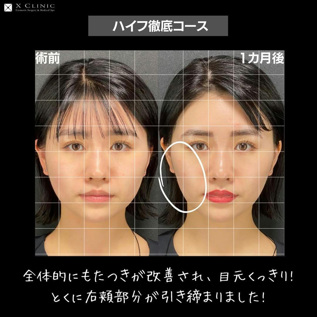 【女性・輪郭】ハイフ徹底コース_before_aftar