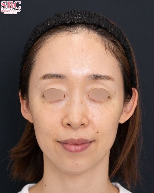 【30代女性・顔】SBCプレミアムPRP皮膚再生療法（額／こめかみ／目の上／法令線）_before