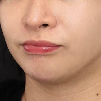 水の森美容クリニック 東京新宿院でエラボトックスを受けたなっちゃんさんの写真