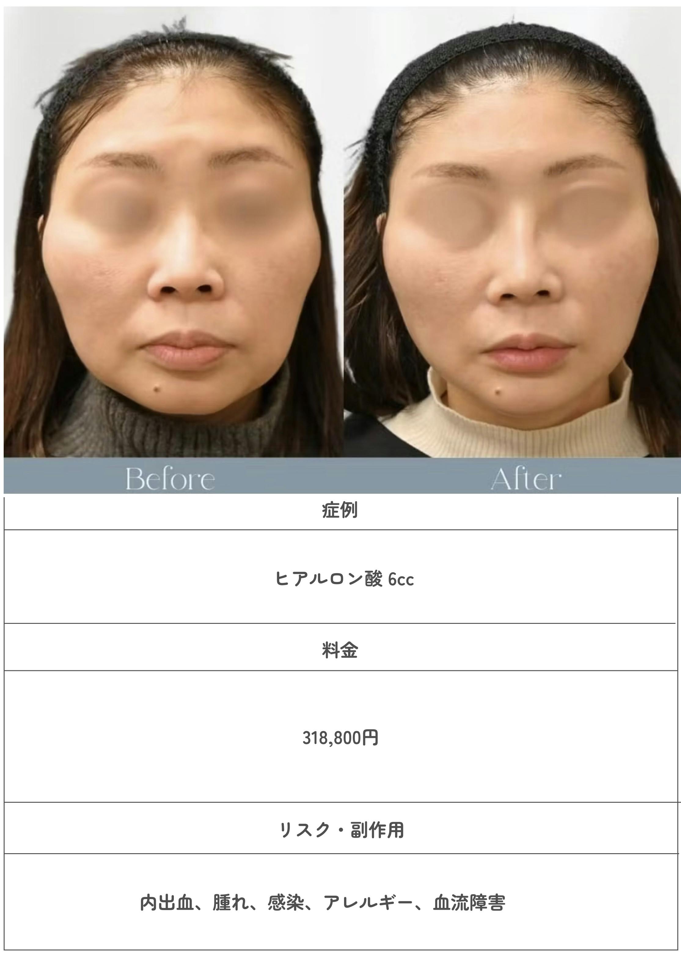 エルムクリニックヒアルロン酸症例のビフォーアフター