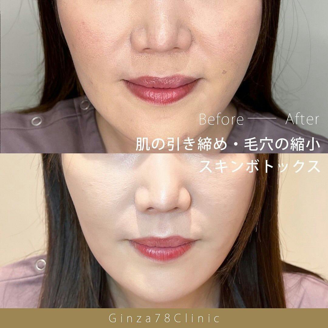 【女性・肌】スキンボトックス_before_aftar