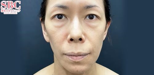 【女性・目元】目の下の切らないクマ・たるみ（ふくらみ）取り、ナチュラル脂肪注射コンデンスリッチ、ナチュラル脂肪注射ナノリッチ_before