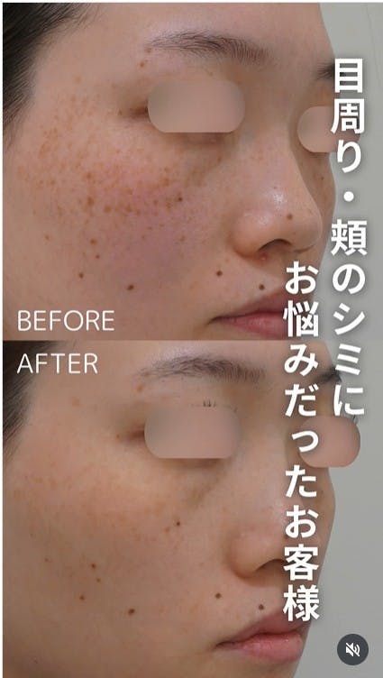 【女性・シミ】ピコレーザー_before_aftar