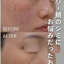 【女性・シミ】ピコレーザー_before_aftar