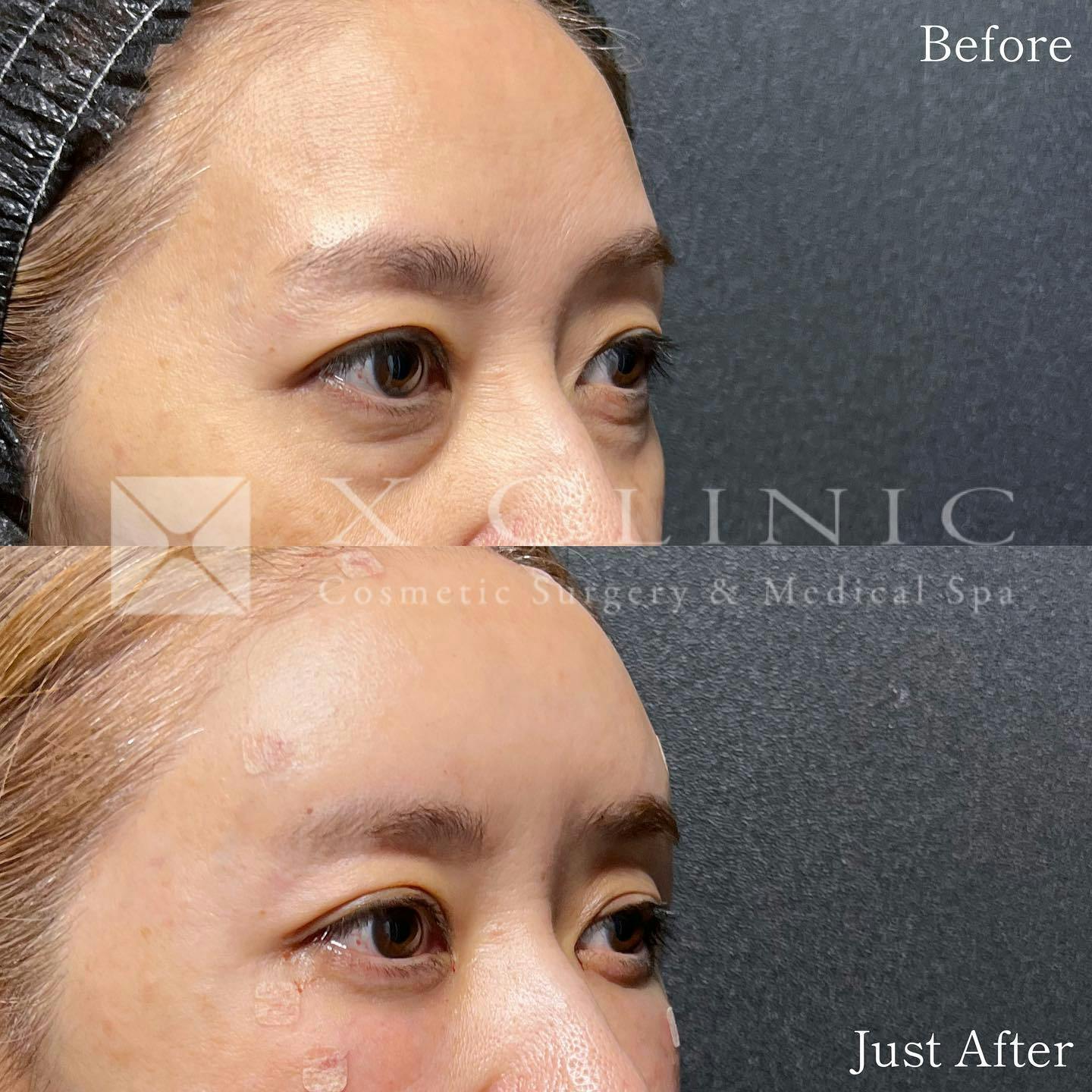 【40代女性・目元】クマ取りフルコース＋ベイビーおでこ＋PRP_before_aftar