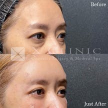 【40代女性・目元】クマ取りフルコース+ベイビーおでこ+PRP_before_aftar