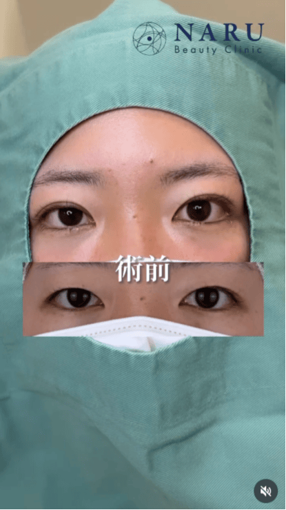 【女性・目元】二重埋没法_before_aftar